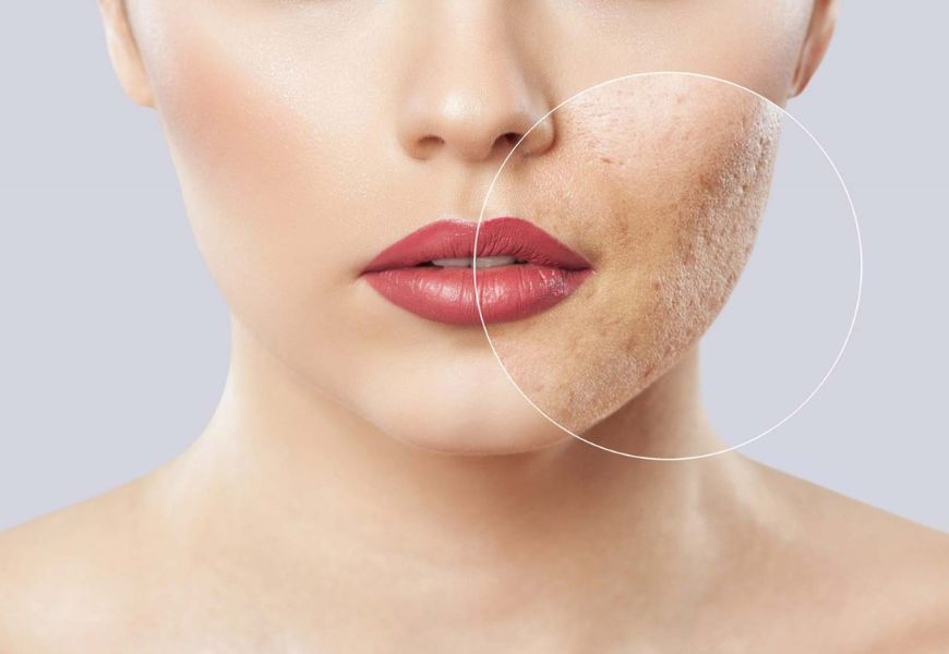 Laser for Acne Scars Treatment Doctors Near Belapur, Navi Mumbai