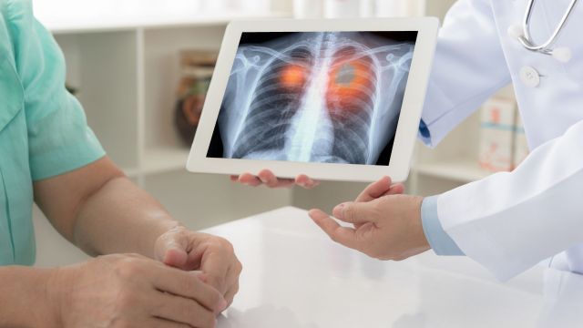 Life After Lung Cancer Treatment: Recovery, Diet & Follow-ups – @almedicaltourism on Tumblr