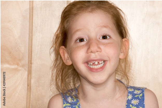Correcting Your Child's Snaggle Tooth: From Causes to Treatments