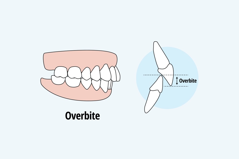 Classifications of Teeth Arrangement in Orthodontics: Class 1, 2, and 3 Explained