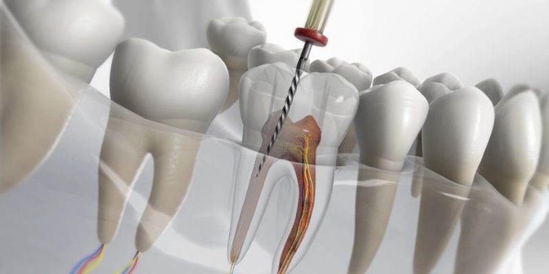 Root Canal Treatment Cost in Zirakpur | Root Canal Treatment Dhakoli