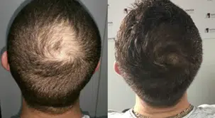 Tarifs/Devis Greffe de Cheveux et Poils | NY Center Rouen