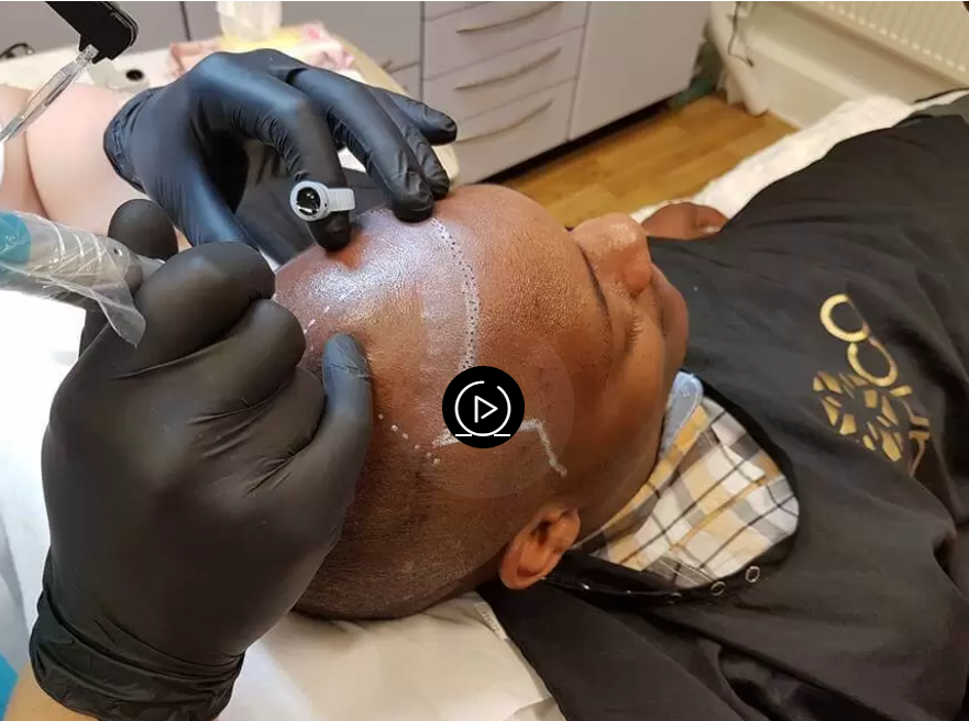 Is Scalp Micro pigmentation Safe? What London Practitioners Want You to Know | by True Scalp Clinic | Sep, 2025 | Medium