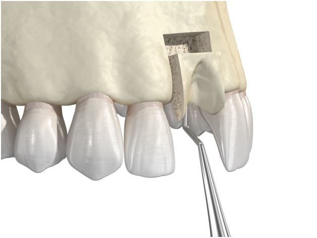 What Is An Allograft? | Allograft Bone Graft Process