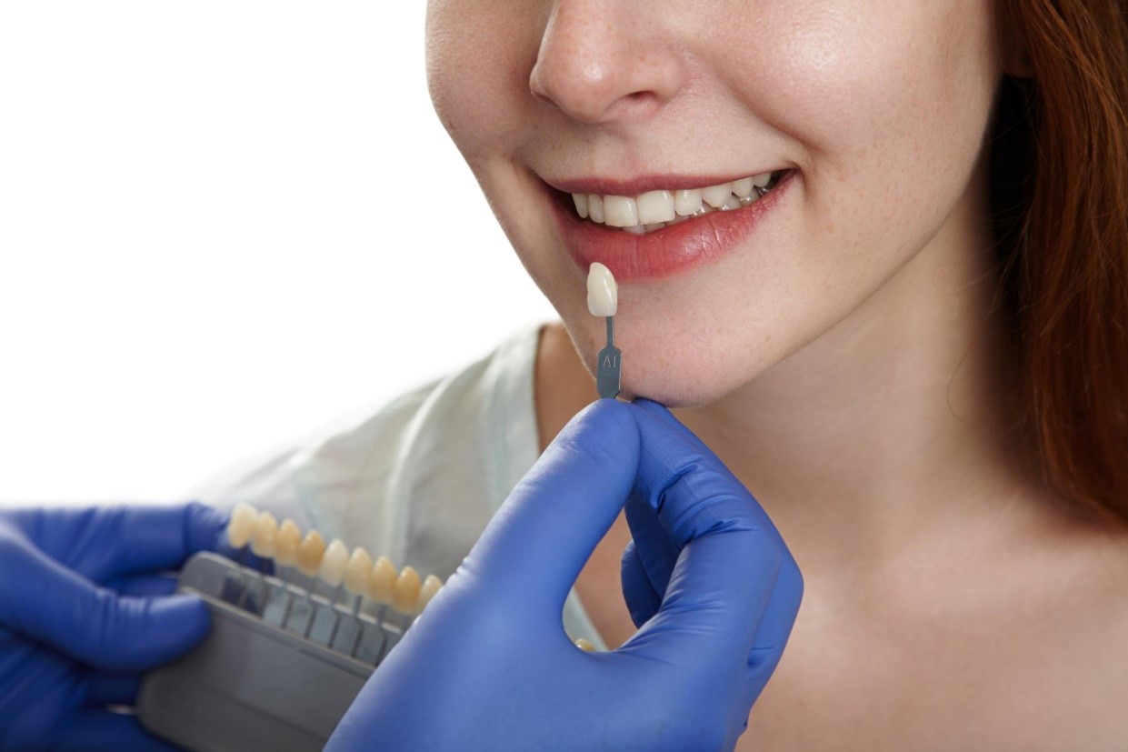 Porcelain Veneer Lifespan: How Long Do They Really Last?