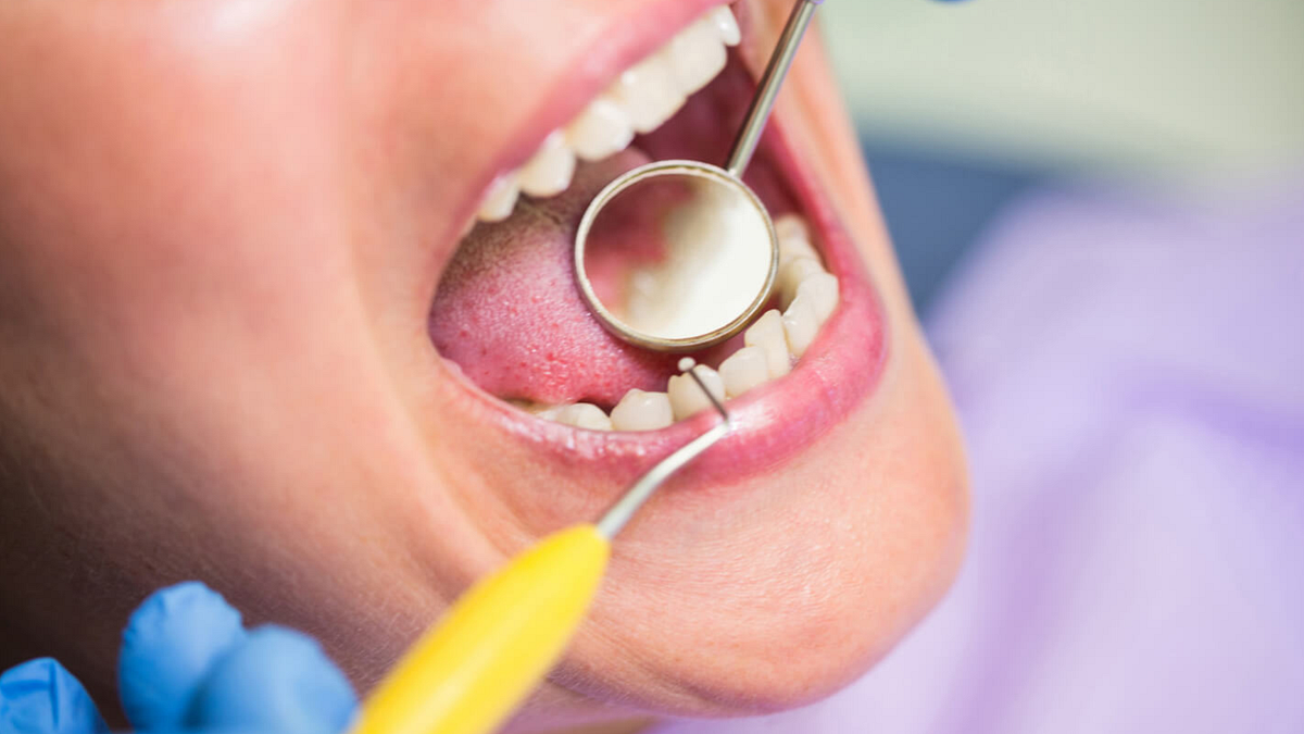 Porcelain vs. Composite Veneers: Which Lasts Longer | by Burton Advance Dental | Oct, 2025 | Medium