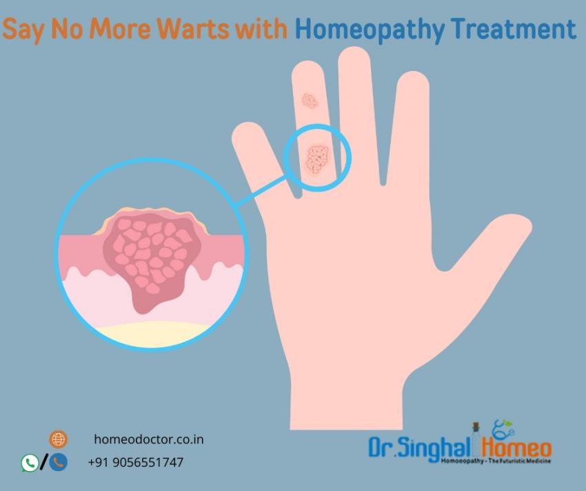 Natural Healing: How Homeopathic Medicine Can Help You Say Goodbye to Warts | daddycow.com