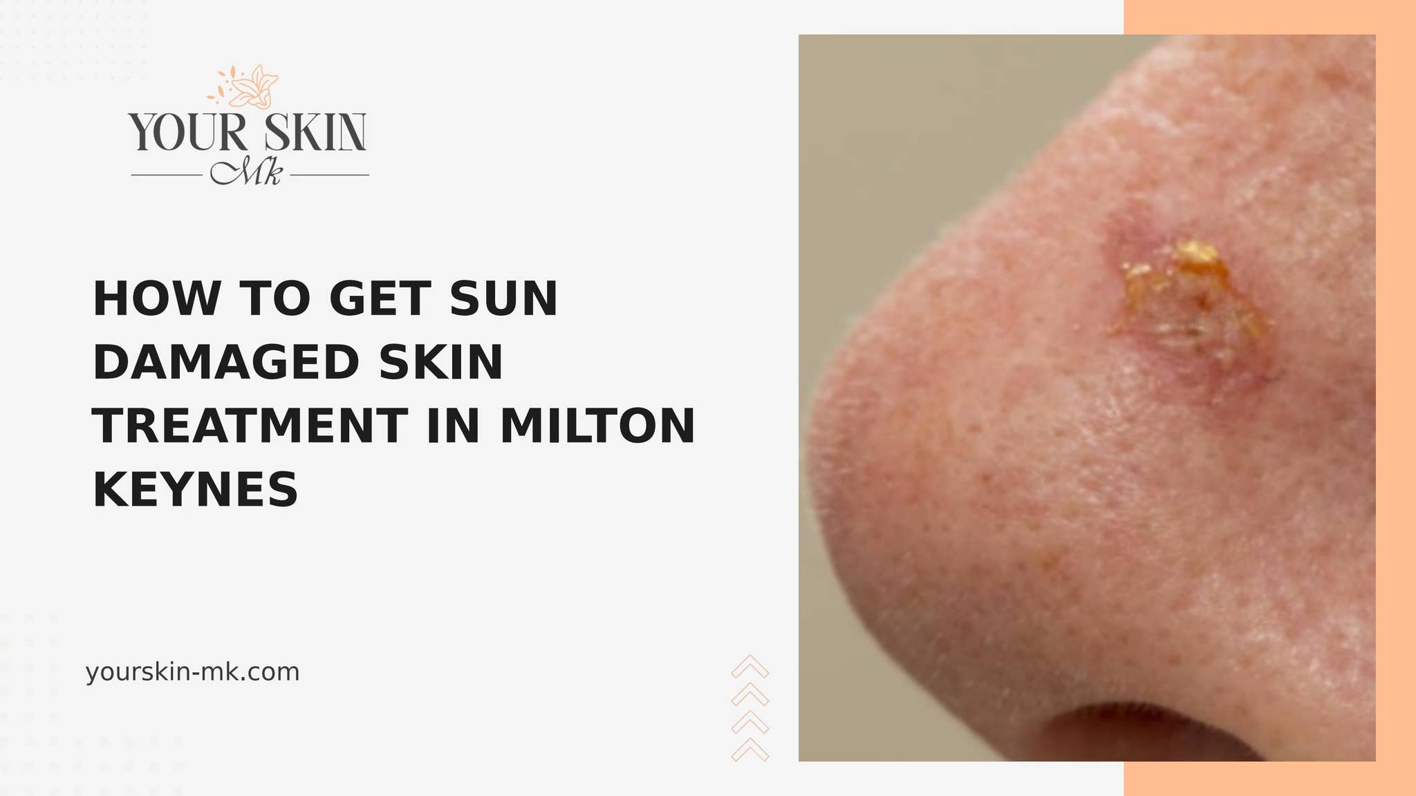 How to Get Sun Damaged Skin Treatment in Milton Keynes by Yourskin Mk - Issuu