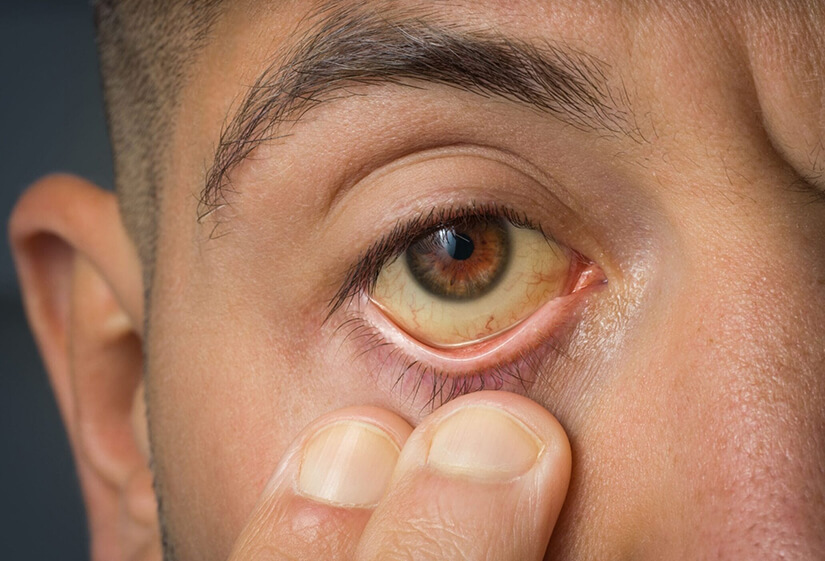 Yellow Eyes (Jaundice Eyes): Causes, Symptoms  Treatments