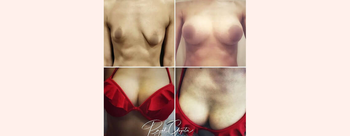 Breast Augmentation: Implants or Fat Transfer? Dr Rajat Gupta
