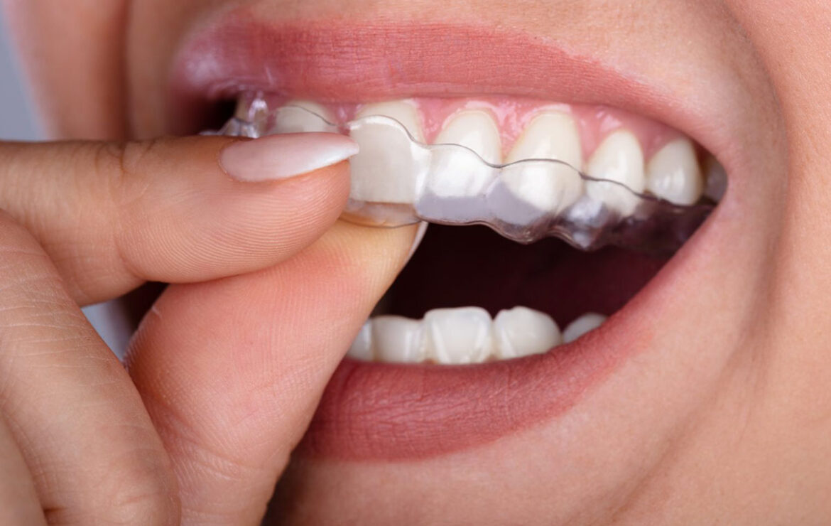 Invisible Aligners in Ahmedabad | Pramukh Dental Care