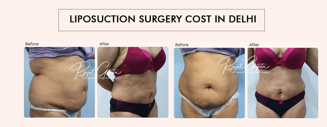 Liposuction Surgery Cost in Delhi -What’s Included and What’s Not