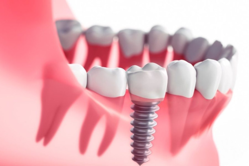 Restore Your Smile with Advanced Dental Implants in Boronia: thesmileclinic1 — LiveJournal