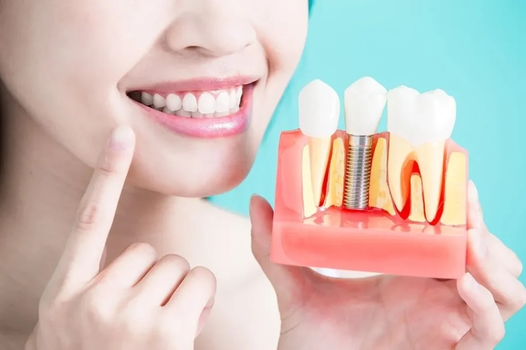 Best Dental Implants in Mississauga: 5 Key Benefits You Should Know – @villagedentalofstreetsville on Tumblr