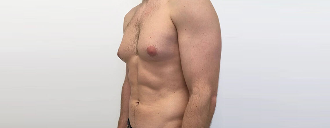 OCCULT Technique Is Changing Gynecomastia Surgery