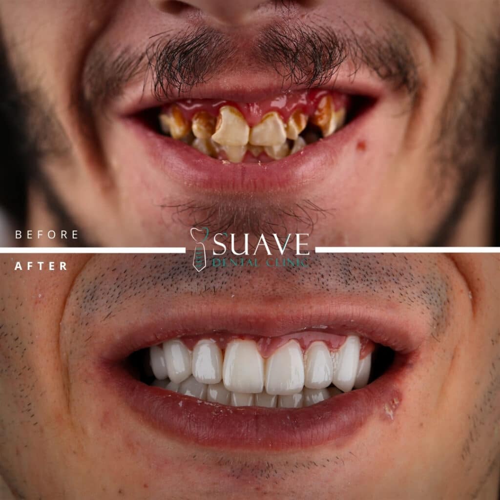 Best Dental Clinic In Istanbul, Turkey - Suave Clinic