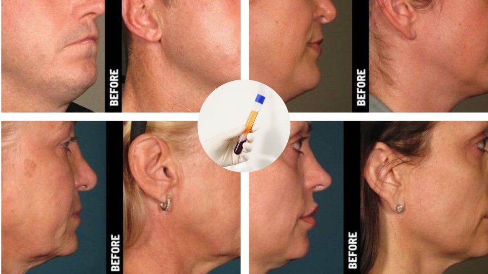 Why Plasma Treatments Will Secure a Permanent Place in Modern Skincare in 2026 - Rutherford Voice