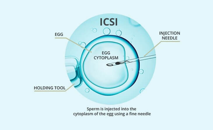 ICSI Packages in Delhi: What’s Included and How to Secure the Best Deal – Excel IVF