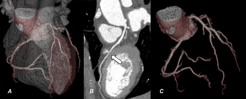 CT Coronarographie Privée À Montréal | Scanner Cardiaque Rapide