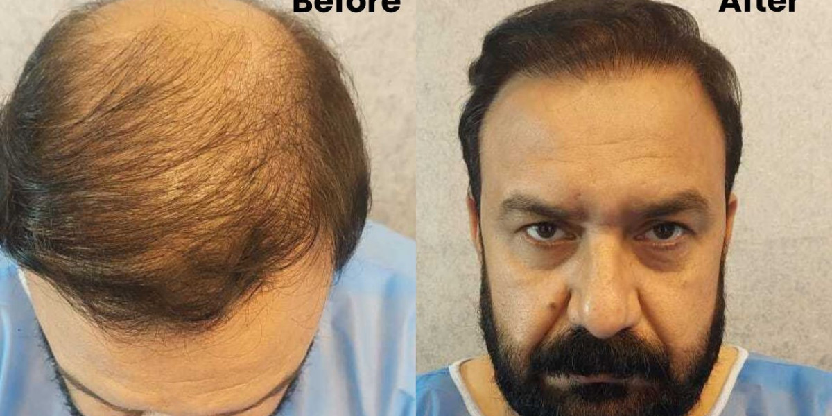 Hair Transplant Clinic Pakistan | Natural, Permanent Hair Restoration for Ages 30–50