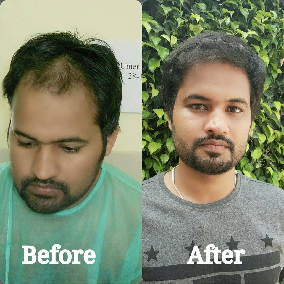 Can PRP Slow Down Ongoing Hair Fall?