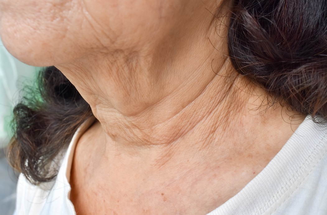 How to Get Rid of Saggy Neck? Exercises  Treatments