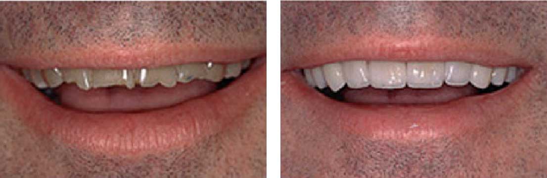 Porcelain Veneers: Aesthetic Solutions by Dr. Bryan G. Foote