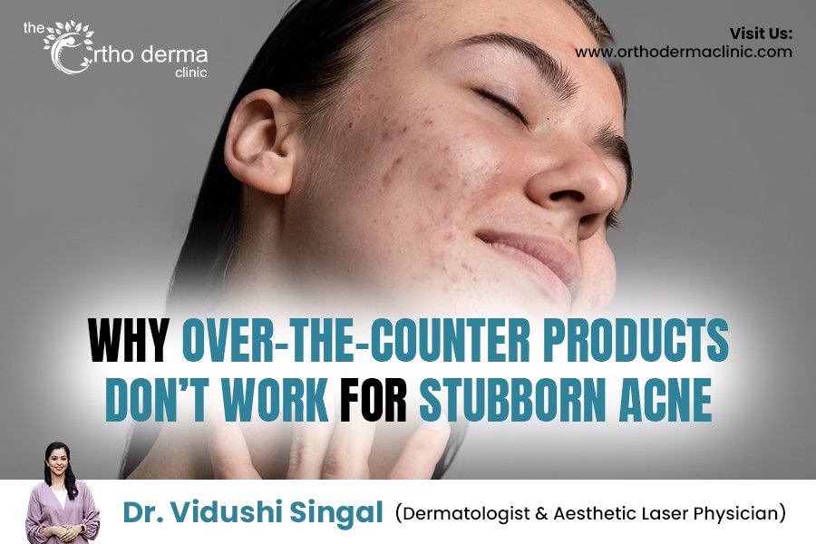 Why Over-the-Counter Products Don’t Work for Stubborn Acne