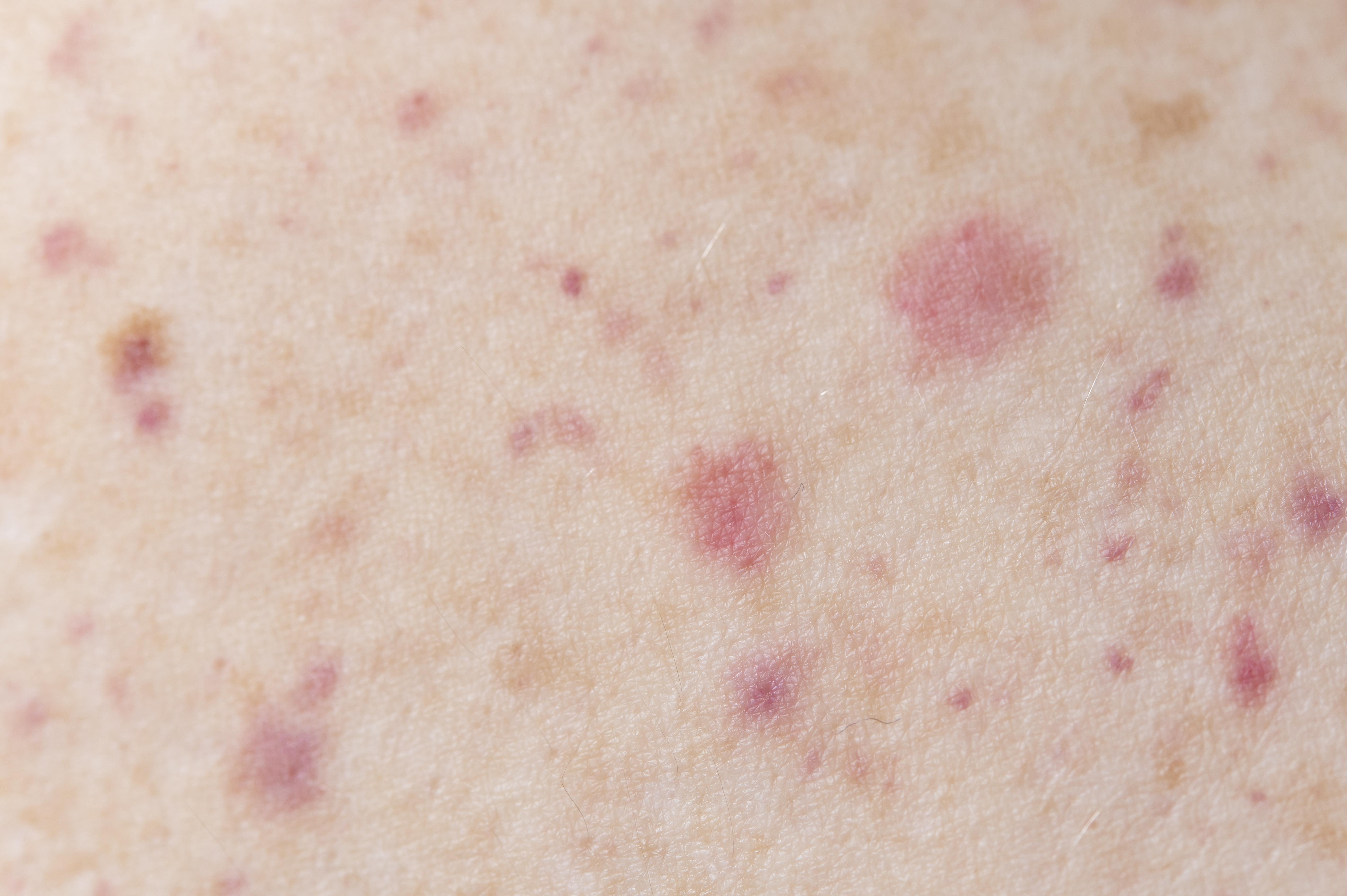 Early Signs of Actinic Keratosis You Shouldn’t Ignore – Site Title