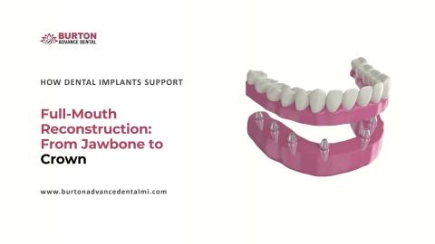 How Dental Implants Support  Full-Mouth Reconstruction From Jawbone to Crown