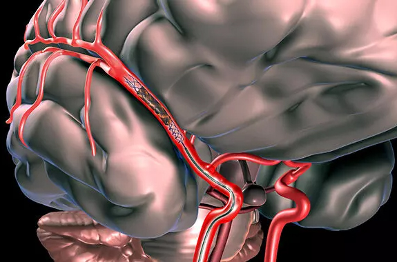 Stroke Symptoms  Treatment Center in Ahmedabad, Udaipur, Bhilwara, Jodhpur, Surat, Gujarat