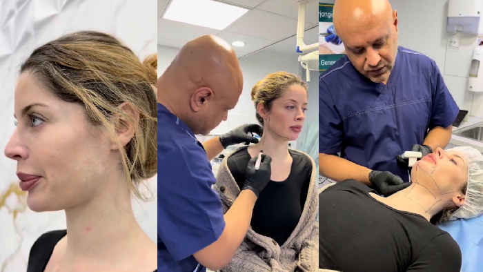 Lipo Laser voor Kaaklijn-definitie: De Beste Niet-Invasieve Behandeling tegen een Dubbele Kin in 2026