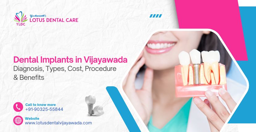 Dental Implants in Vijayawada: Cost, Diagnosis, Types, Procedure  Benefits