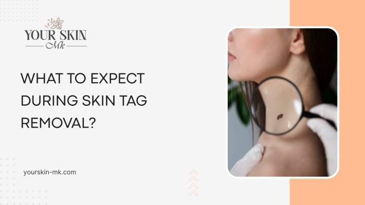 PPT - What to Expect During Skin Tag Removal PowerPoint Presentation, free download - ID:14761992
