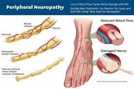 Peripheral Neuropathy Specialist California: Expert Care for Nerve Health